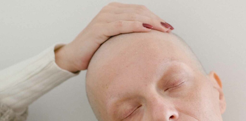 Cancer patient after chemotherapy